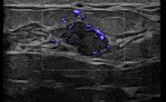 BREAST 4 129 1600 1000 80