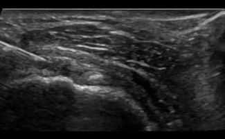 dry needling ston tenonta