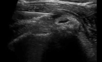 enchyse anaisthetikou