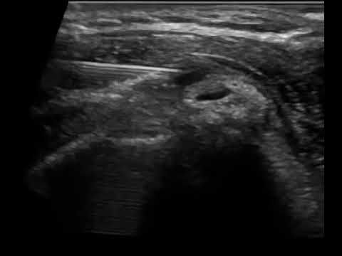 enchyse anaisthetikou