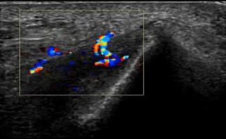 enchyse anaisthetikou se