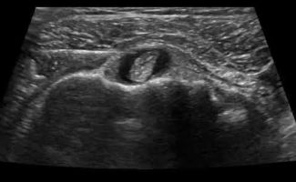 enese sto elytro tou dikephalou