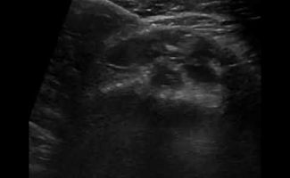 enese sto elytro tou tenonta