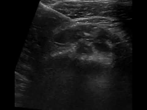 enese sto elytro tou tenonta