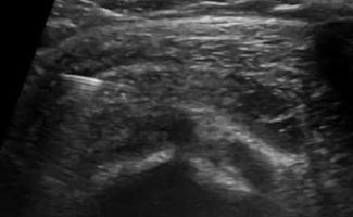 enese ston ypakromiako thylako