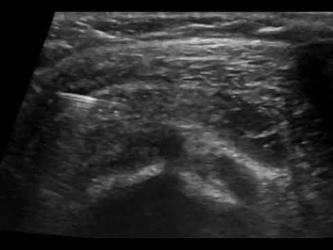 enese ston ypakromiako thylako