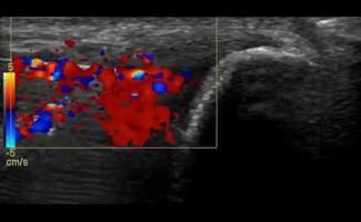 prp se epikondylitida